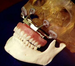 Image showing Biomodel with dental articulator.