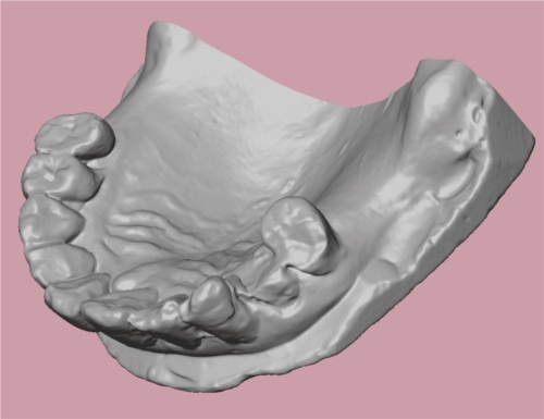 3D surface data from laser scan of dental cast.