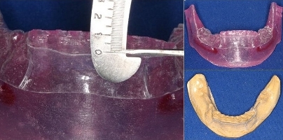 Image showing biomodel of mandible with cutting guide.