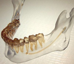 Image of epoxy mandibular model with condyles included.