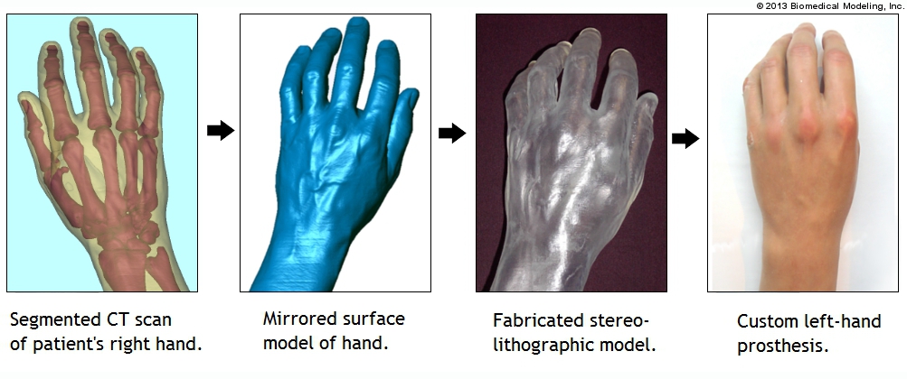 Biomodel progression of creating a custom hand prosthesis.
