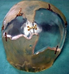 Biomodel template and implants for cranioplasty.