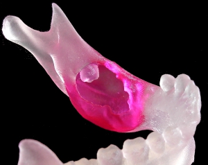 Model of mandible with tumor in red.